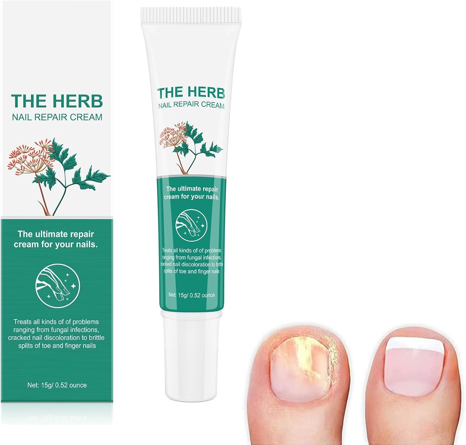 Micosis Uñas De Pies, Micosis Tratamiento De Uñas, Micosis Pie, Micosis Pie Tratamiento, Tratamiento De Micosis Pie, Tratamiento De Las Uñas, Tratamiento De Micosis De Uñas De Pie