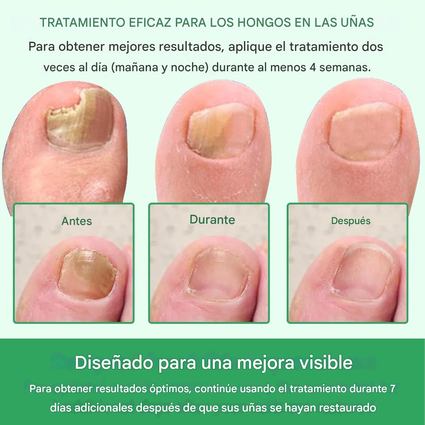 Tratamiento Antihongos para Uñas 60ml – Con Extracto de Jengibre | Repara, Fortalece y Regenera Uñas de Manos y Pies